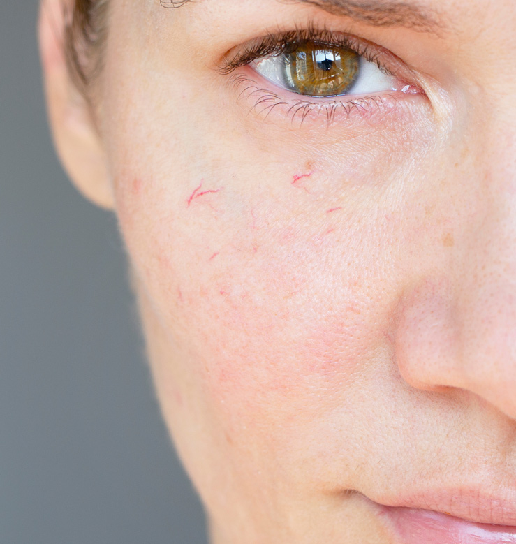arañas-vasculares-eliminar-laser-eimec-clinic-barcelona-medicina-estetica